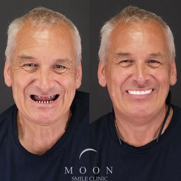 Moon Smile Clinic Dental Implants Moon Smile Clinic Dental Implants