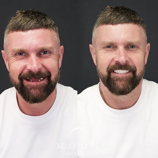 Moon Smile Clinic Dental Implants Moon Smile Clinic Dental Implants