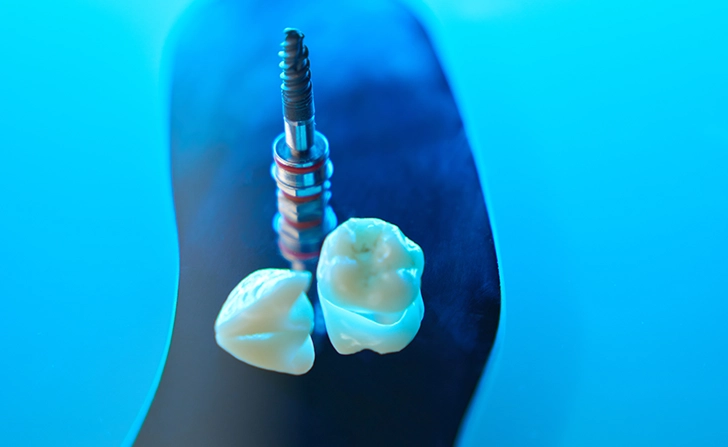 Dental Implant Antalya dental-implant