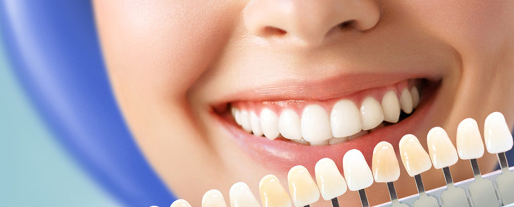 Laminate Veneers Antalya laminate-veneers-turkey